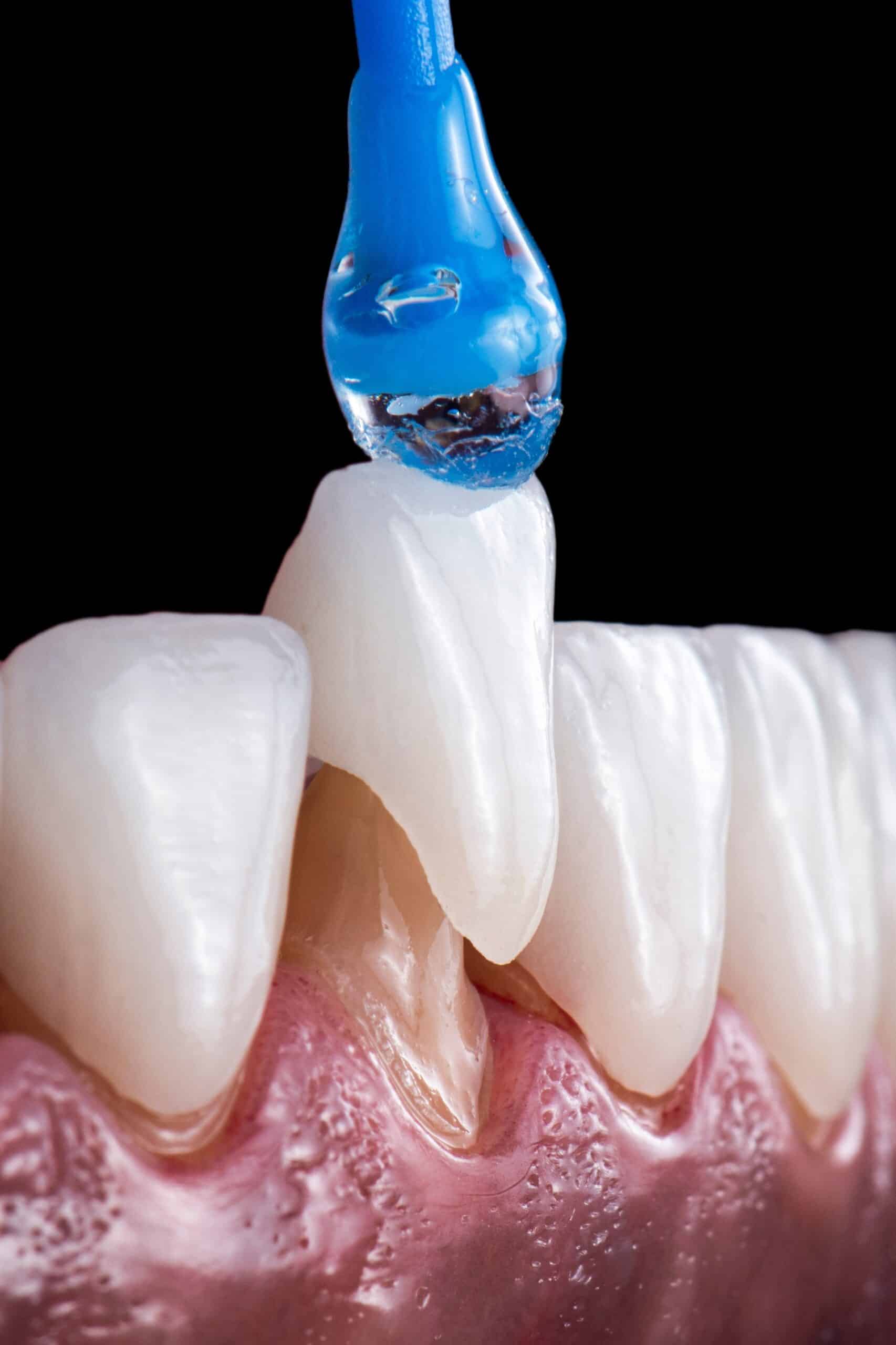 dental crowns horizon city