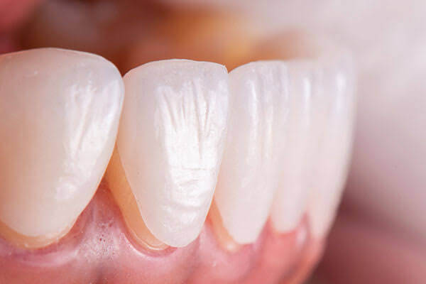 Close-up of natural-looking porcelain veneers on upper front teeth